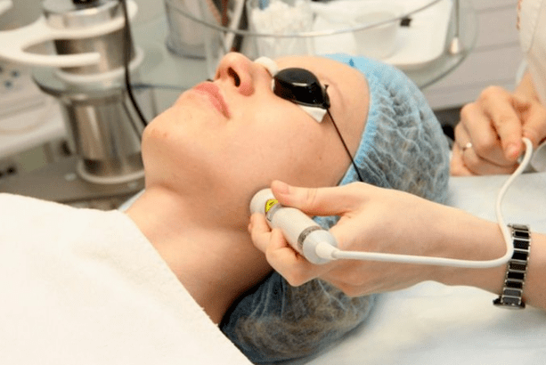 Laserová biorevitalizácia