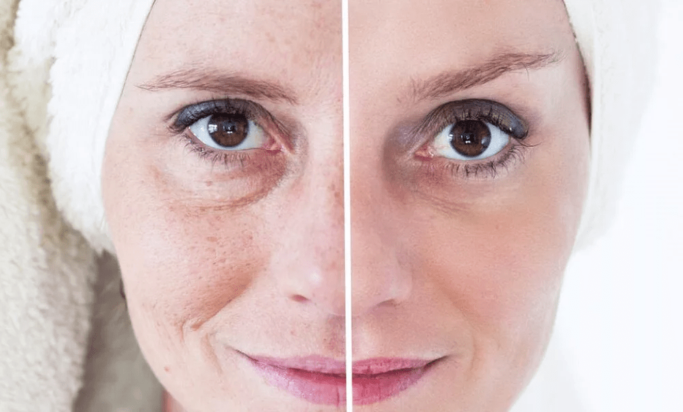 laserové omladenie tváre